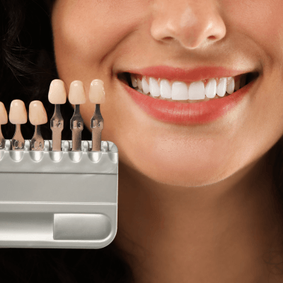 Cosmetic Bonding By Evercrest Dental