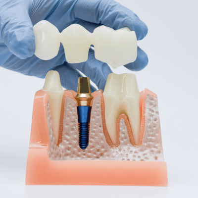 Dental Bridges By Evercrest Dental