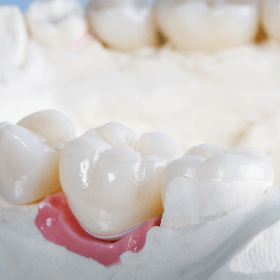 Dental Crowns By Evercrest Dental