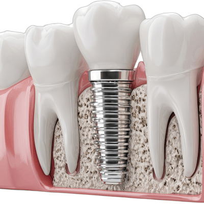 Dental Implants By Evercrest Dental