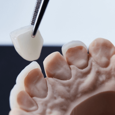 Dental Veneers By Evercrest Dental