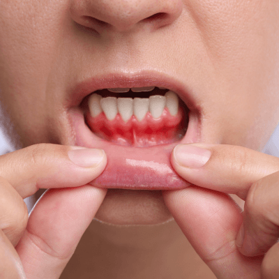 Gum Disease Treatment By Evercrest Dental