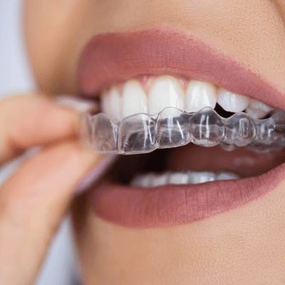 Night Guards By Evercrest Dental