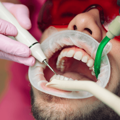 Professional Teeth Cleaning By Evercrest Dental