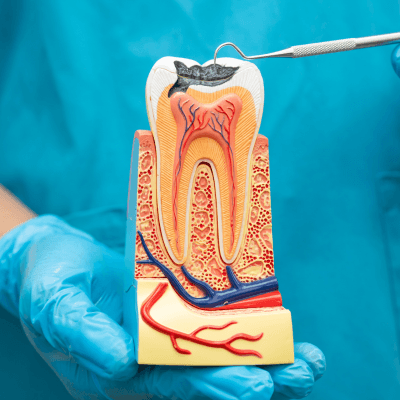 Root Canal Therapy By Evercrest Dental