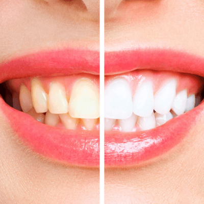 Teeth Whitening By Evercrest Dental