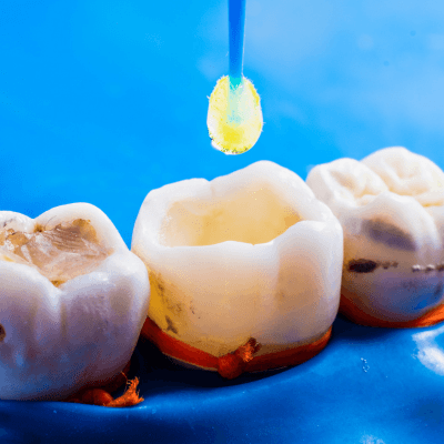 Tooth-Coloured Fillings By Evercrest Dental