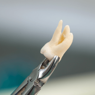 Tooth Extractions By Evercrest Dental
