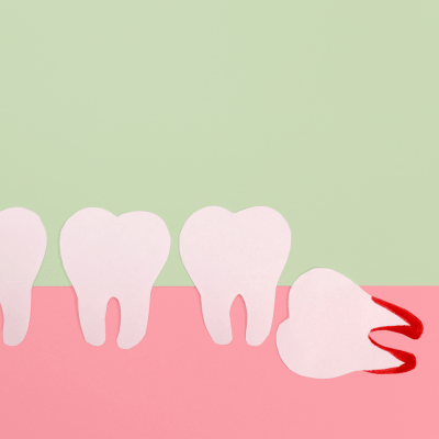 Wisdom Tooth Extractions By Evercrest Dental
